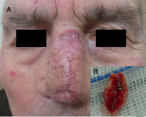 A. Pápula perlada de 1,5 centímetros de diámetro sobre la cicatriz previa. B. Pieza quirúrgica con el alambre de sutura de acero en su interior.