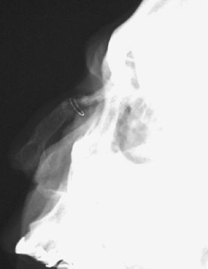 Radiografía de huesos propios. Alambre de sutura radioopaco e injerto de cadera sustituyendo la anatomía nasal normal.