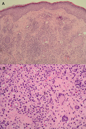 A. Infiltrado inflamatorio difuso en la dermis. Epidermis sin alteraciones histológicas significativas (HE x25). B. El infiltrado inflamatorio era linfoplasmocitario y contenía aisladas células gigantes multinucleadas (HE x200).