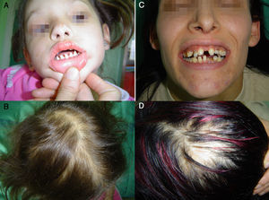 A and B. Clinical features of the proband. C and D. Clinical features of the proband's mother. The proband has pointed teeth, absence of the tails of the eyebrows, a congenital scaring lesion on her nose (A), and sparse thin hair (B). Her mother exhibits similar clinical signs (C and D). She never developed her adult dentition.