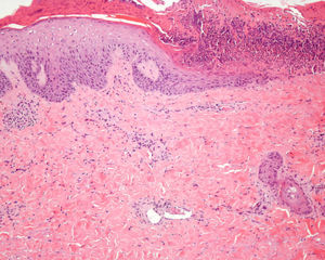 (H-E x100). Necrosis epidérmica que corresponde clínicamente a la zona de la costra, colágeno dérmico degenerado y en la dermis superficial trombos de fibrina ocupando la luz de los vasos.