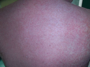 Múltiples pústulas no foliculares sobre una base eritematoedematosa.