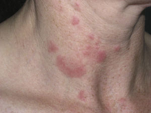 Lesiones características de lupus eritematoso túmido (LET) en el cuello.