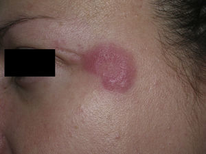 Lesiones características de lupus eritematoso túmido (LET) en la cara.