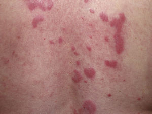 Lesiones características de lupus eritematoso túmido (LET) en la espalda.