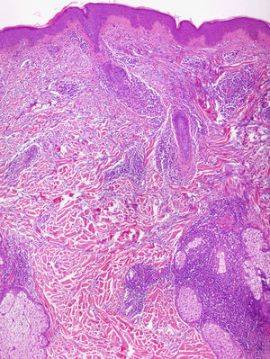 Biopsia de LET que muestra un infiltrado linfocitario perivascular y perianexial con depósito intersticial de mucina, sin alteraciones epidérmicas (fotografía cedida por la Dra. M.T. Fernández-Figueras) (Hematoxilina-eosina x 40).