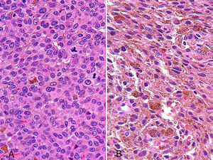 Histológicamente el tumor se corresponde con melanocitos epiteliodes (A) y fusiformes (B) atípicos densamente pigmentados con un crecimiento en parte difuso y en parte nodular (HE- x4).