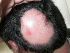 Placa de alopecia areata en el vértex un año después de comenzar tratamiento con adalimumab.