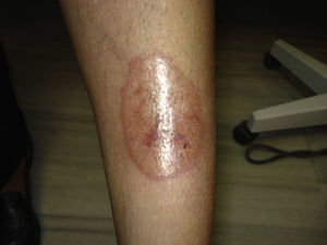 Placa de necrobiosis lipoídica con ulceración inicial.