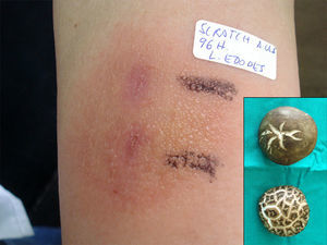 «Scratch-test» positivo a las 96 horas con vesiculación. En esquina inferior derecha setas del género Shiitake que aportó la paciente.