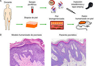 Modelización de enfermedades cutáneas de alta prevalencia. (A) Modelo humanizado de psoriasis basado en la inyección intradérmica, en la piel humana regenerada, de subpoblaciones de células T diferenciadas a un fenotipo T1 junto con la inyección de citoquinas de tipo Th17, (IL-17 e IL-22) seguido de la eliminación/perturbación mecánica del estrato córneo mediante tape-striping. (B) El modelo recapitula las principales características fenotípicas de la enfermedad tales como elongación y fusión de los puentes interpapilares, paraqueratosis, aumento de la vascularización y capilares dilatados, entre otras (H&E, 20×).