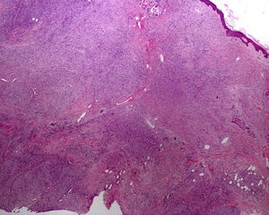 Hematoxilina-eosina, x2. Dermatofibrosarcoma protuberans que alcanza borde profundo de biopsia excisional.
