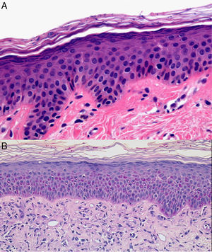 A) Hematoxilina-eosina, x40. En capa córnea se observan estructuras alargadas y ovaladas de coloración azulada, que se corresponden con el Malassezia spp. B) PAS, x4. Se observan hifas en capa córnea: tiña.