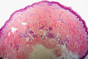 Hematoxilina-eosina, x2. Necrosis epidérmica y dérmica con imágenes de trombosis e hialinosis parietal en dermis compatibles con el diagnóstico de vasculopatía livedoide. En zona dermohipodérmica, vasos con focos de necrosis fibrinoide segmentaria diagnósticos de panarteritis nudosa.