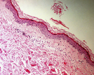 Hematoxilina-eosina. x10. Infiltrados linfocíticos perivasculares con leucocitoclasia. Clínicamente sospecha de vasculitis leucocitoclástica, que se confirmó en biopsias posteriores.
