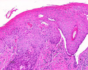 Hematoxilina-eosina x100. VIN usual. Queratinocitos con halo blanco perinuclear y núcleos irregulares en todo el espesor epidérmico que corresponden a coilocitos.