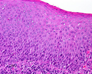 Hematoxilina-eosina x200. VIN diferenciado o simple. Alteración dismadurativa en el tercio inferior de la epidermis. Mitosis aisladas. Paraqueratosis asociada.