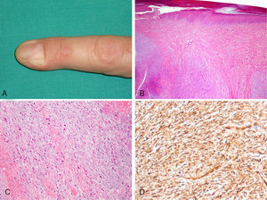 A) Nódulo subcutáneo en el segundo dedo de la mano izquierda, que deforma parcialmente la matriz ungueal. B) Tumoración dérmica constituida por áreas fibromixoides y mixoides dispuestas de forma alternante. C) Células fusiformes incluidas en un estroma mixoide. También se observan numerosos mastocitos de núcleo redondo y citoplasma más amplio (hematoxilina-eosina X100). D) Positividad citoplasmática difusa para CD34 en las células neoplásicas (X200).