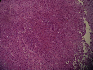 Granuloma supurativo por micobacterias.
