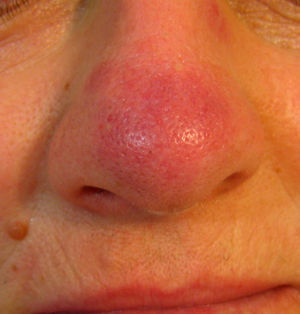 Placa eritemato-violácea en dorso nasal.