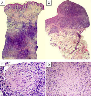 A) Presencia de un infiltrado linfocitario que ocupa la dermis reticular, en el cual se distinguen estructuras granulomatosas sin necrosis central (HE x1,25). B) Detalle de un granuloma constituido por células gigantes multinucleadas y epitelioides y rodeado por una corona linfocitaria (HE x40). C) Denso infiltrado linfocitario ocupando el corion (HE x4). D) A mayor detalle, se observan células epitelioides constituyendo granulomas no necrotizantes (HEx40).