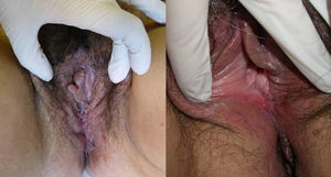 Mucosa vulvar edematosa, con apariencia granulomatosa. Erosiones en la cara interna de labios menores.
