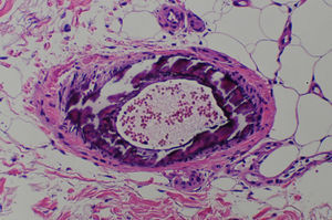 Biopsia cutánea que demuestra calcificación intramural e hiperplasia de la íntima en una arteriola del tejido celular subcutáneo (H&E x 400).
