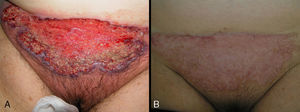 Imágenes antes (A) y después (B) del tratamiento con prednisona oral.