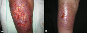 Imágenes antes (A) y después (B) del tratamiento con adalimumab combinado con sulafasalazina en paciente con PG y espondilitis anquilosante.