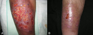 Imágenes antes (A) y después (B) del tratamiento con adalimumab combinado con sulafasalazina en paciente con PG y espondilitis anquilosante.