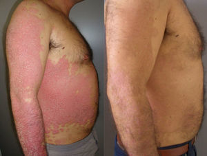 Paciente número 1 tratado con fototerapia domiciliaria (A: inicio PASI 15,2; B: a los 4 meses PASI 2,4).