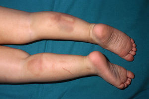 La presencia de hematomas en distintos estadios evolutivos y los aspectos lineales son altamente sugestivos de maltrato. (Imagen gentilmente cedida por el Dr. Jordi Pou del Hospital Sant Joan de Déu, Barcelona, España.)