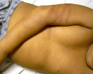 La linealidad en los brazos que envuelve la zona es típico de los azotes con correas. (Imagen gentilmente cedida por el Dr. Jordi Pou del Hospital Sant Joan de Déu de Barcelona.)
