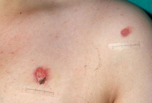 Las quemaduras por cigarrillo son fáciles de diagnosticar y en ocasiones se asocian a abuso sexual. (Imagen gentilmente cedida por el Dr. Jordi Pou del Hospital Sant Joan de Déu, Barcelona, España.)
