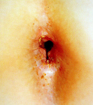 Un abuso sexual reciente por vía anal. El desgarro muestra la violencia del acto. (Imagen gentilmente cedida por el Dr. Jordi Pou del Hospital Sant Joan de Déu, Barcelona, España.)