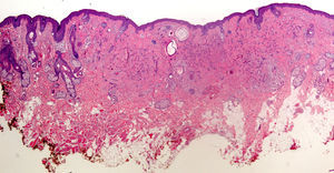 Hematoxilina-eosina x2. Tricoepitelioma desmoplásico. Como se ve en la imagen la existencia de cordones de células epiteliodes en la dermis reticular haría complicado descartar que se tratase de un epitelioma basocelular esclerosante en biopsias incisionales pequeñas.