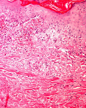 Vasculitis leucocitoclástica de pequeño vaso, así como necrosis incipiente de la epidermis. La IFD confirmó depósitos de IgA permitiendo realizar el diagnóstico de vasculitis de Shönlein-Henoch.