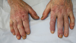Úlceras digitales bilaterales en el territorio del nervio mediano. Se observa acortamiento del 2.° dedo de la mano derecha.