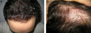 a. Región frontal y b. del área cicatricial 6 meses después de la cirugía.
