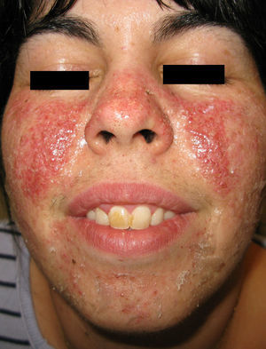 Imagen clínica de las lesiones antes de comenzar el tratamiento. Múltiples angiofibromas faciales de predominio en ambas mejillas, con fondo eritematoso prominente.