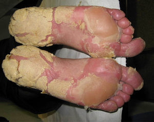 Aspecto de las plantas con marcada hiperqueratosis antes de comenzar tratamiento.