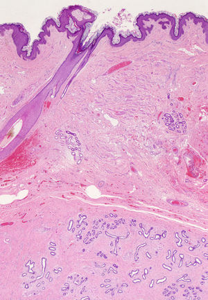 Imagen microscópica panorámica de la lesión (HE 10x).