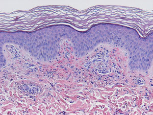 Vasculitis leucocitoclástica: leucocitoclastia, extravasación hemática (H-E, x10).