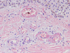 Necrosis fibrinoide de la pared vascular (H-E, x40).