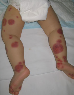 Máculas purpúricas de aspecto contusiforme: edema agudo hemorrágico del lactante.