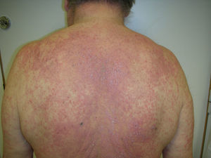 Lesiones maculopapulosas eritematovioláceas, confluentes en placas localizadas en espalda.