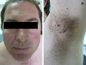 Tricodiscomas y fibrofoliculomas en paciente con síndrome Birt-Hogg-Dubé.