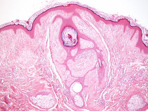 Imagen histológica de un fibrofoliculoma (hematoxilina-eosina x100).