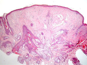 Imagen histológica de un tricodiscoma (hematoxilina-eosina x100).