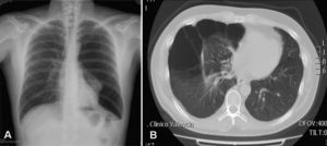 A. Radiografía simple de tórax en la que se aprecia neumotórax espontáneo izquierdo en un paciente con síndrome Birt-Hogg-Dubé. B. TAC torácica que muestra múltiples quistes pulmonares derechos en un paciente con el síndrome.
